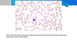 Iron Deficiency Anemia: understanding through a case study | PPTX