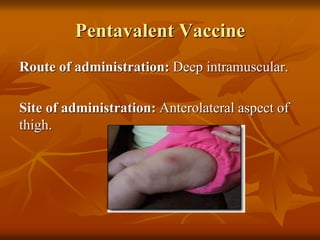 Pentavalent Vaccine
Route of administration: Deep intramuscular.
Site of administration: Anterolateral aspect of
thigh.
 
