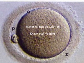Maternal non disjunction
Known risk factors
 