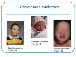 Chromosome syndromes
Down's syndrome
Trisomy 21
Edward's syndrome
Trisomy 18
Patau's syndrome
Trisomy 13
 