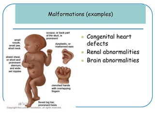 Malformations (examples)
 Congenital heart
defects
 Renal abnormalities
 Brain abnormalities
 