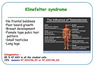 Cytogenetics :
85 % 47,XXY in all the studied cells
15% mosaics 47,XXY/46,XY or 47,XXY/46,XX
Klinefelter syndrome
•No frontal baldness
•Poor beard growth
•Breast development
•Female type pubic hair
pattern
•Small testicles
•Long legs
 