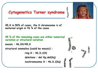 45,X in 50% of cases, the X chromosome is of
maternal origin in 76 % of the cases
45 % of the remaining cases are either numerical
variation or structural variation
mosaic : 46,XX/45,X
structural anomalies (could be mosaic) :
ring X : 46,X,r(X)
deletions : del Xp,del(Xq)
isochromosome X : 46,X,i(Xq)
Cytogenetics Turner syndrome
 