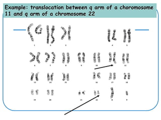 Example: translocation between q arm of a choromosome
11 and q arm of a chromosome 22
 
