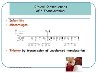 Clinical Consequences
of a Translocation
 Infertility
 Miscarriages
 Trisomy by transmission of unbalanced translocation
Ogur et al. 2006, Berend et al. 2000, 2002
 