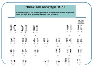 Normal male Karyoytype 46,XY
R-banding (right)is the reverse pattern of G bands (left) so that G-positive
bands are light with R-banding methods, and vice versa
 