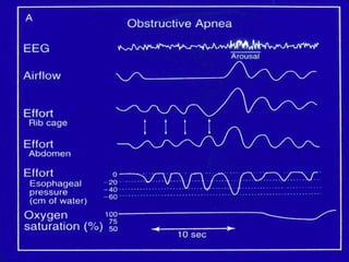 Pathophysiology of Sleep Apnea
Awake: Small airway + neuromuscular compensation
Loss of neuromuscular
compensation
+
Decre...