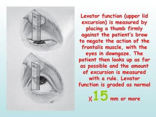 Normal Levator Function Numero-Ophthalmology ! | PPT
