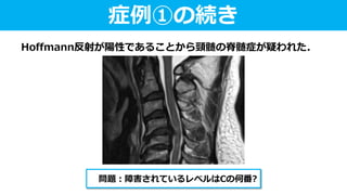 Hoffmann反射が陽性であることから頸髄の脊髄症が疑われた.
症例①の続き
問題：障害されているレベルはCの何番?
 