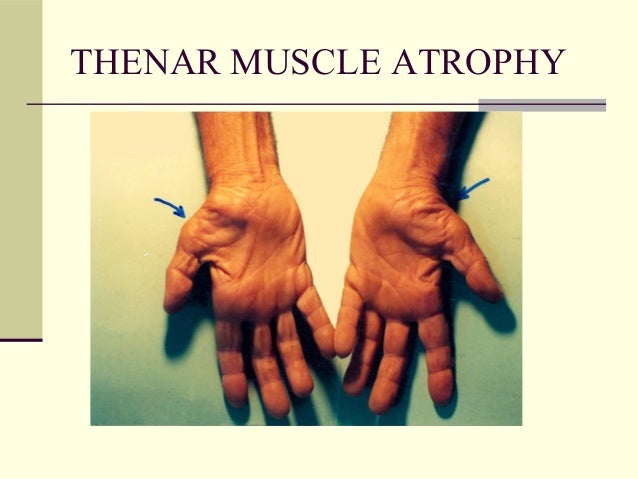 Numbness in the extremities 2