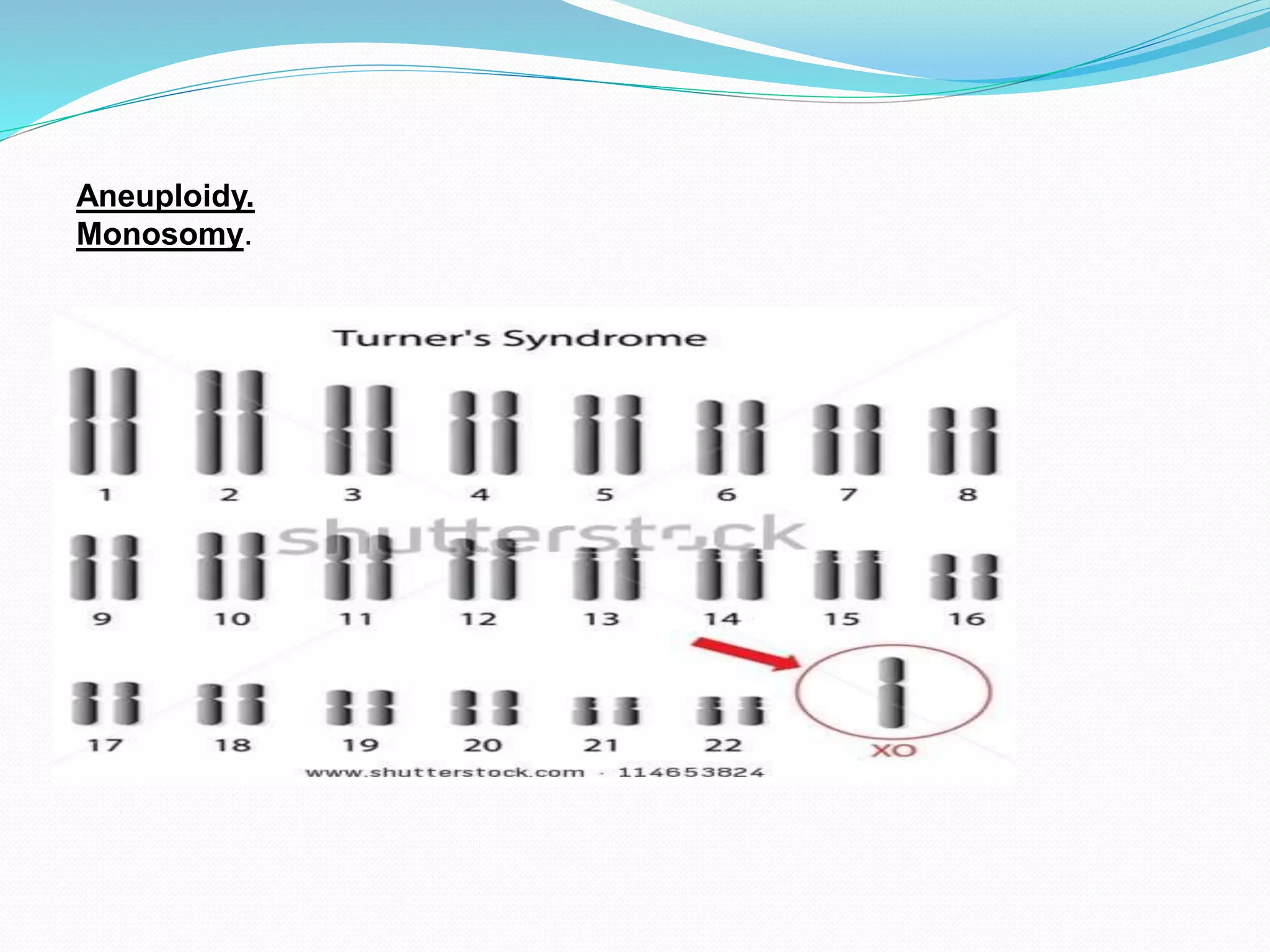 Aneuploidy.
Monosomy.
