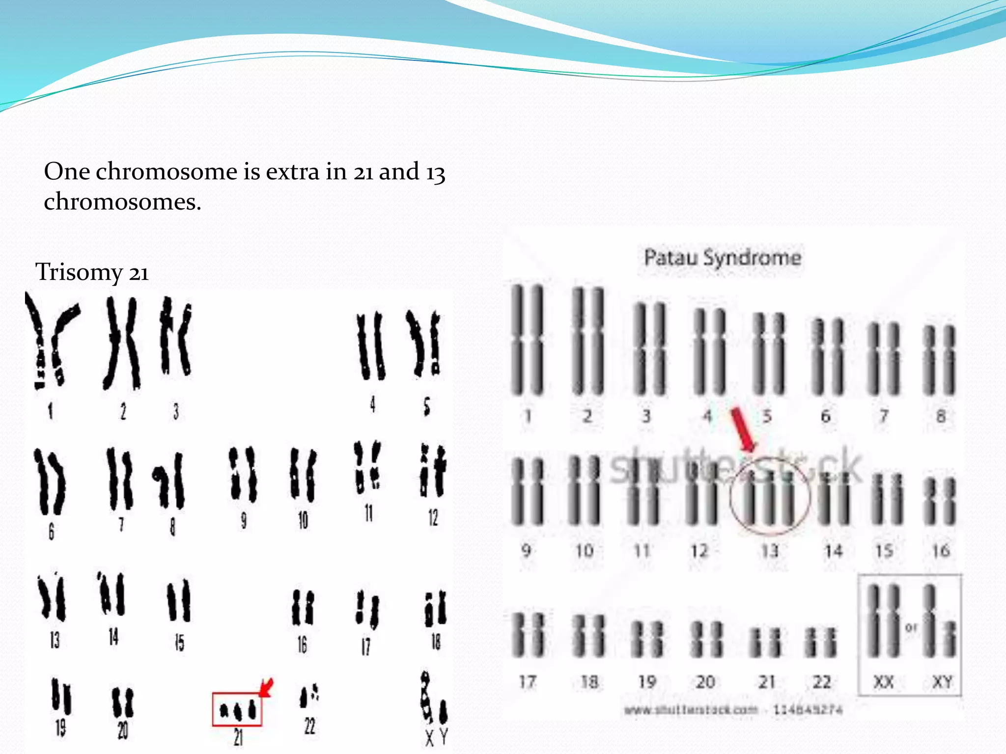 One chromosome is extra in 21 and 13
chromosomes.
Trisomy 21