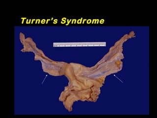 Turner’s Syndrome
 