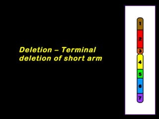 Deletion – Terminal
deletion of short arm
 