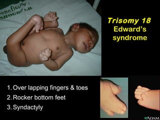 Trisomy 18
Edward’s
syndrome
1.Over lapping fingers & toes
2.Rocker bottom feet
3.Syndactyly
 