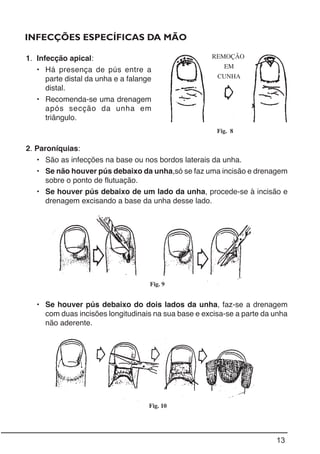 13
Fig. 9
Fig. 8
INFECÇÕES ESPECÍFICAS DA MÃO
2. Paroníquias:
• São as infecções na base ou nos bordos laterais da unha.
• Se não houver pús debaixo da unha,só se faz uma incisão e drenagem
sobre o ponto de flutuação.
• Se houver pús debaixo de um lado da unha, procede-se à incisão e
drenagem excisando a base da unha desse lado.
• Se houver pús debaixo do dois lados da unha, faz-se a drenagem
com duas incisões longitudinais na sua base e excisa-se a parte da unha
não aderente.
1. Infecção apical:
• Há presença de pús entre a
parte distal da unha e a falange
distal.
• Recomenda-se uma drenagem
após secção da unha em
triângulo.
Fig. 10
REMOÇÃO
EM
CUNHA
 