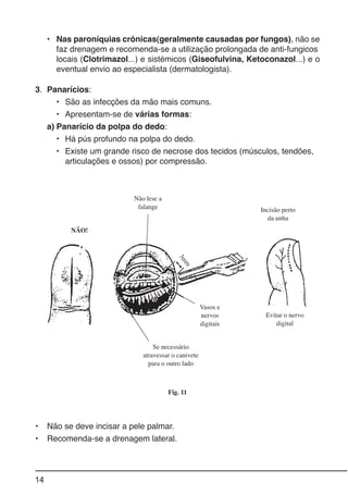 14
Fig. 11
• Nas paroníquias crónicas(geralmente causadas por fungos), não se
faz drenagem e recomenda-se a utilização prolongada de anti-fungicos
locais (Clotrimazol...) e sistémicos (Giseofulvina, Ketoconazol...) e o
eventual envio ao especialista (dermatologista).
3. Panarícios:
• São as infecções da mão mais comuns.
• Apresentam-se de várias formas:
a) Panarício da polpa do dedo:
• Há pús profundo na polpa do dedo.
• Existe um grande risco de necrose dos tecidos (músculos, tendões,
articulações e ossos) por compressão.
• Não se deve incisar a pele palmar.
• Recomenda-se a drenagem lateral.
NÃO!
Não lese a
falange Incisão perto
da unha
Vasos e
nervos
digitais
Se necessário
atravessar o canivete
para o outro lado
Evitar o nervo
digital
3
m
m
 