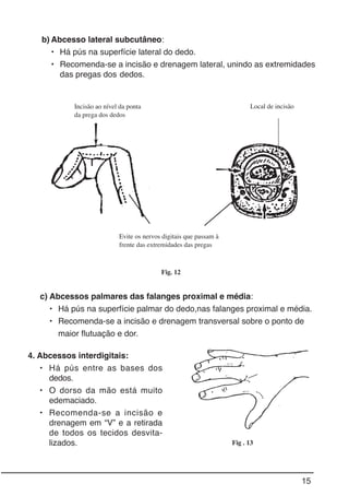 15
Fig. 12
c) Abcessos palmares das falanges proximal e média:
• Há pús na superfície palmar do dedo,nas falanges proximal e média.
• Recomenda-se a incisão e drenagem transversal sobre o ponto de
maior flutuação e dor.
Fig . 13
b) Abcesso lateral subcutâneo:
• Há pús na superfície lateral do dedo.
• Recomenda-se a incisão e drenagem lateral, unindo as extremidades
das pregas dos dedos.
Incisão ao nível da ponta
da prega dos dedos
Evite os nervos digitais que passam à
frente das extremidades das pregas
Local de incisão
4. Abcessos interdigitais:
• Há pús entre as bases dos
dedos.
• O dorso da mão está muito
edemaciado.
• Recomenda-se a incisão e
drenagem em “V” e a retirada
de todos os tecidos desvita-
lizados.
 