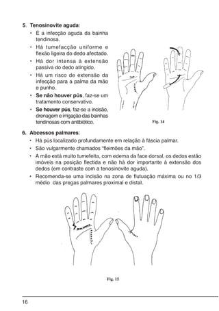 16
6. Abcessos palmares:
• Há pús localizado profundamente em relação à fáscia palmar.
• São vulgarmente chamados “fleimões da mão”.
• A mão está muito tumefeita, com edema da face dorsal, os dedos estão
imóveis na posição flectida e não há dor importante à extensão dos
dedos (em contraste com a tenosinovite aguda).
• Recomenda-se uma incisão na zona de flutuação máxima ou no 1/3
médio das pregas palmares proximal e distal.
Fig. 14
Fig. 15
5. Tenosinovite aguda:
• É a infecção aguda da bainha
tendinosa.
• Há tumefacção uniforme e
flexão ligeira do dedo afectado.
• Há dor intensa à extensão
passiva do dedo atingido.
• Há um risco de extensão da
infecção para a palma da mão
e punho.
• Se não houver pús, faz-se um
tratamento conservativo.
• Se houver pús, faz-se a incisão,
drenagem e irrigação das bainhas
tendinosas com antibiótico.
 