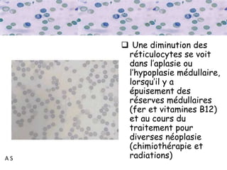 A S
 Une diminution des
réticulocytes se voit
dans l’aplasie ou
l’hypoplasie médullaire,
lorsqu’il y a
épuisement des
réserves médullaires
(fer et vitamines B12)
et au cours du
traitement pour
diverses néoplasie
(chimiothérapie et
radiations)
 