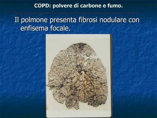 COPD: polvere di carbone e fumo.

Il polmone presenta fibrosi nodulare con
   enfisema focale.
 