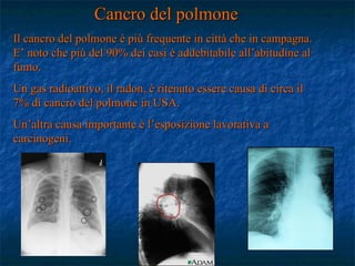 Cancro del polmone
Il cancro del polmone è più frequente in città che in campagna.
E’ noto che più del 90% dei casi è addebitabile all’abitudine al
fumo.
Un gas radioattivo, il radon, è ritenuto essere causa di circa il
7% di cancro del polmone in USA.
Un’altra causa importante è l’esposizione lavorativa a
carcinogeni.
 