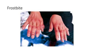 Frostbite
 