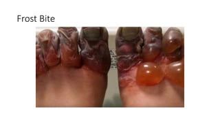 Frost Bite
 