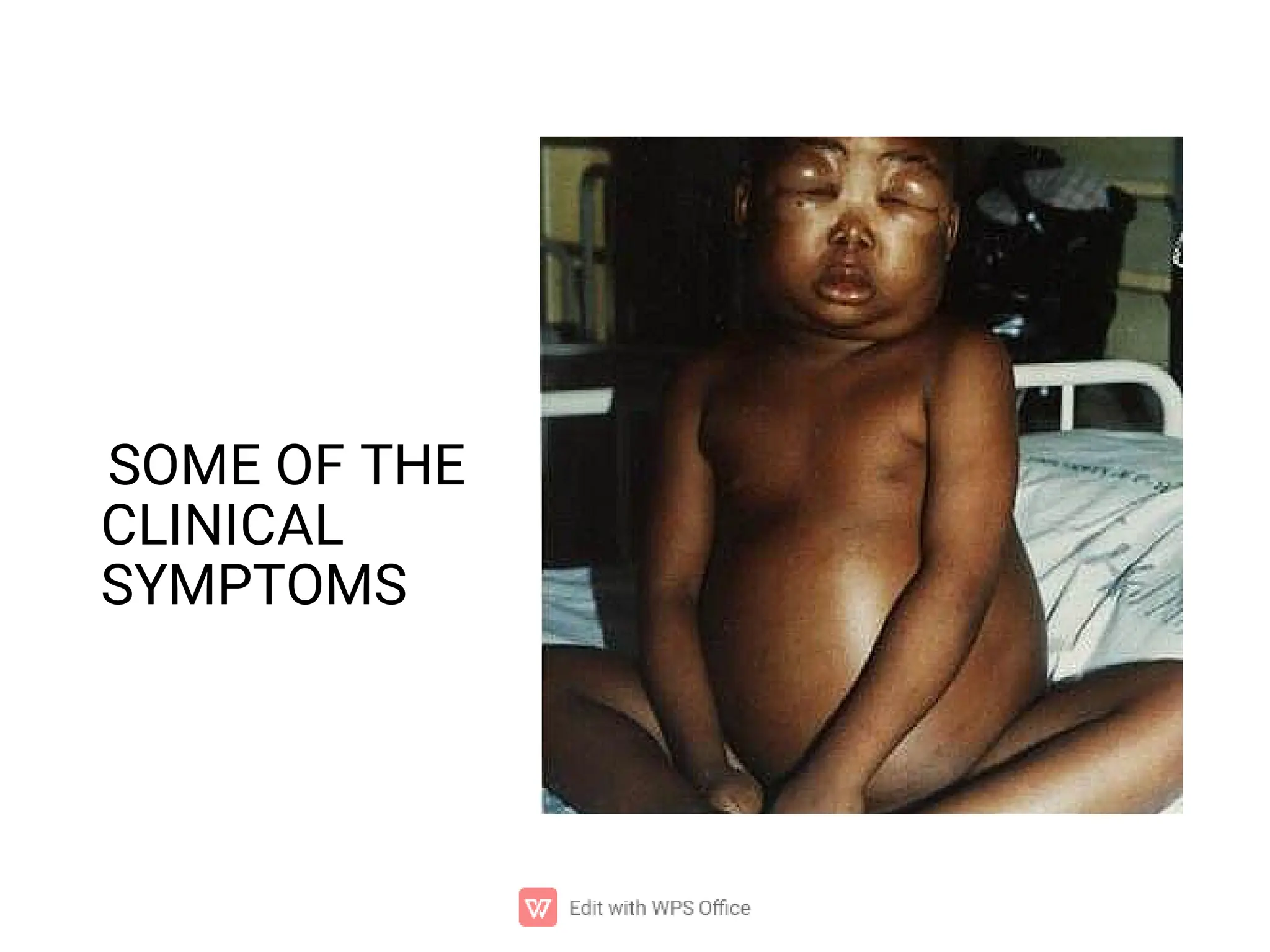 SOME OF THE
CLINICAL
SYMPTOMS
 