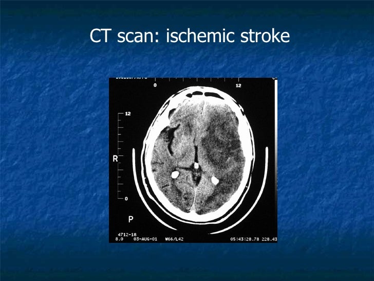 Everything About Stroke Victims
