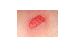 Chronic inflammation, Wound healing - Pathology - Nursing | PDF