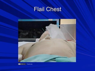 Flail Chest

Trauma.org

 