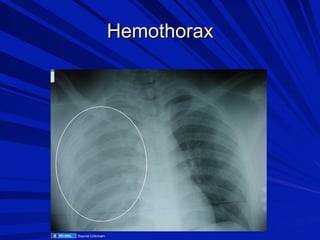 Hemothorax

Source Unknown

 