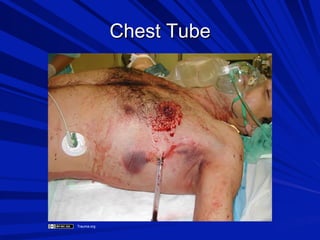 Chest Tube

Trauma.org

 
