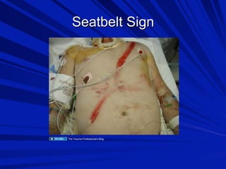 Seatbelt Sign

The Trauma Professional's Blog

 