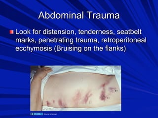 Abdominal Trauma

 Look for distension, tenderness, seatbelt

marks, penetrating trauma, retroperitoneal
ecchymosis (Bruising on the flanks)

Source Unknown

 