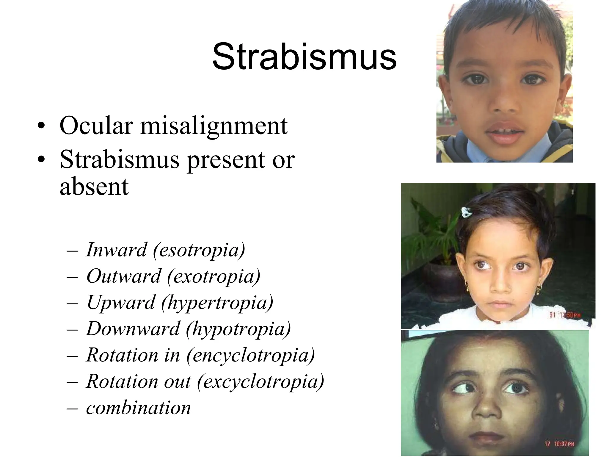 Strabismus Ocular misalignment Strabismus present or absent Inward (esotropia) Outward (exotropia) Upward (hypertropia) Downward (hypotropia) Rotation in (encyclotropia) Rotation out (excyclotropia) combination 