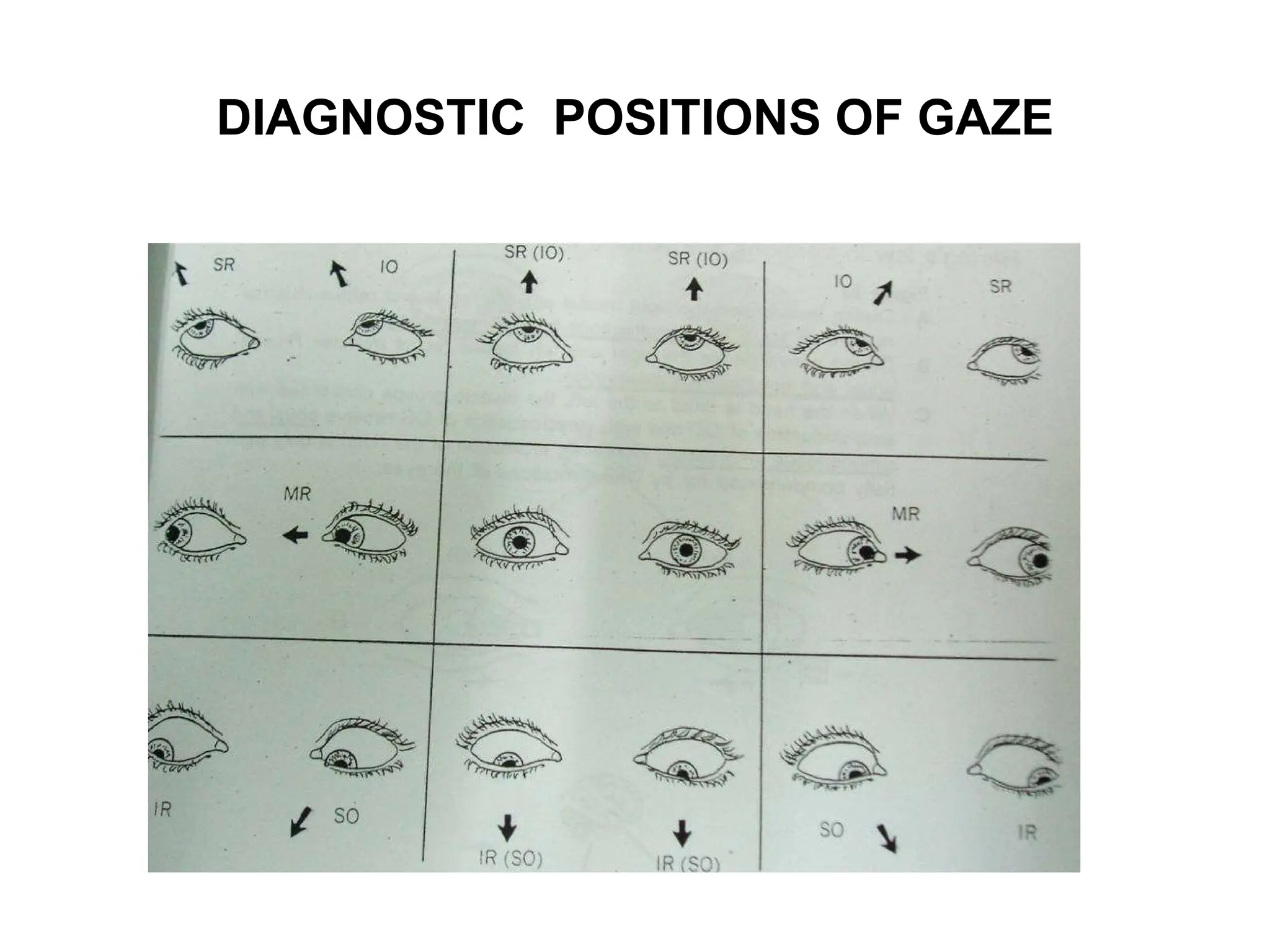 DIAGNOSTIC  POSITIONS OF GAZE 
