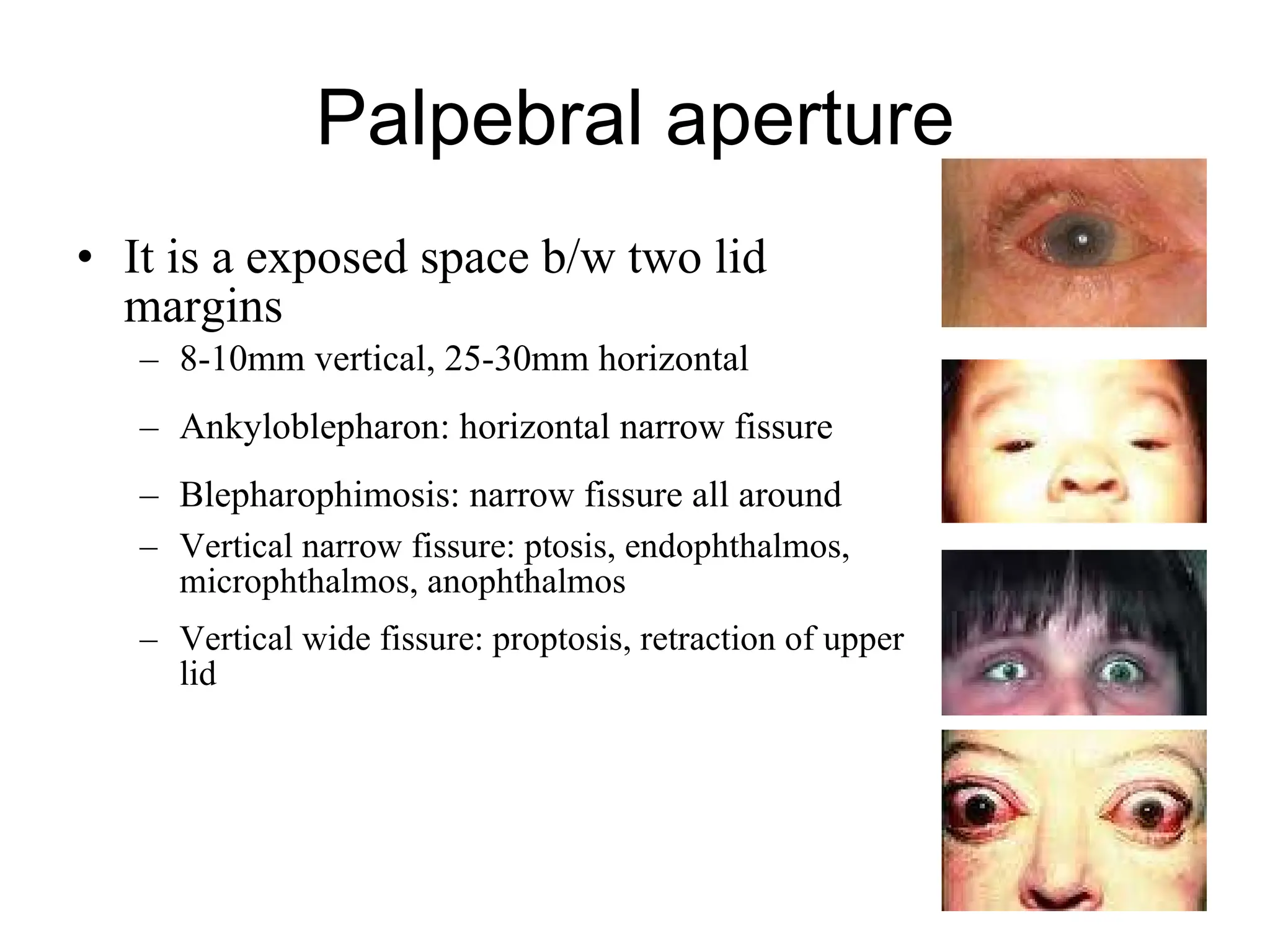 Palpebral aperture It is a exposed space b/w two lid margins 8-10mm vertical, 25-30mm horizontal Ankyloblepharon: horizontal narrow fissure Blepharophimosis: narrow fissure all around Vertical narrow fissure: ptosis, endophthalmos, microphthalmos, anophthalmos Vertical wide fissure: proptosis, retraction of upper lid 