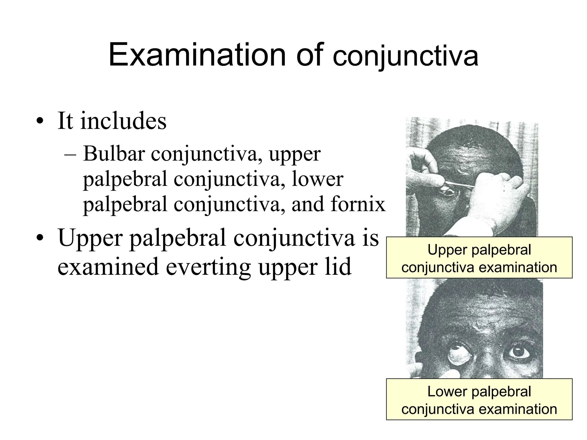 Examination of  conjunctiva It includes Bulbar conjunctiva, upper palpebral conjunctiva, lower palpebral conjunctiva, and fornix Upper palpebral conjunctiva is examined everting upper lid Upper palpebral conjunctiva examination Lower palpebral conjunctiva examination 