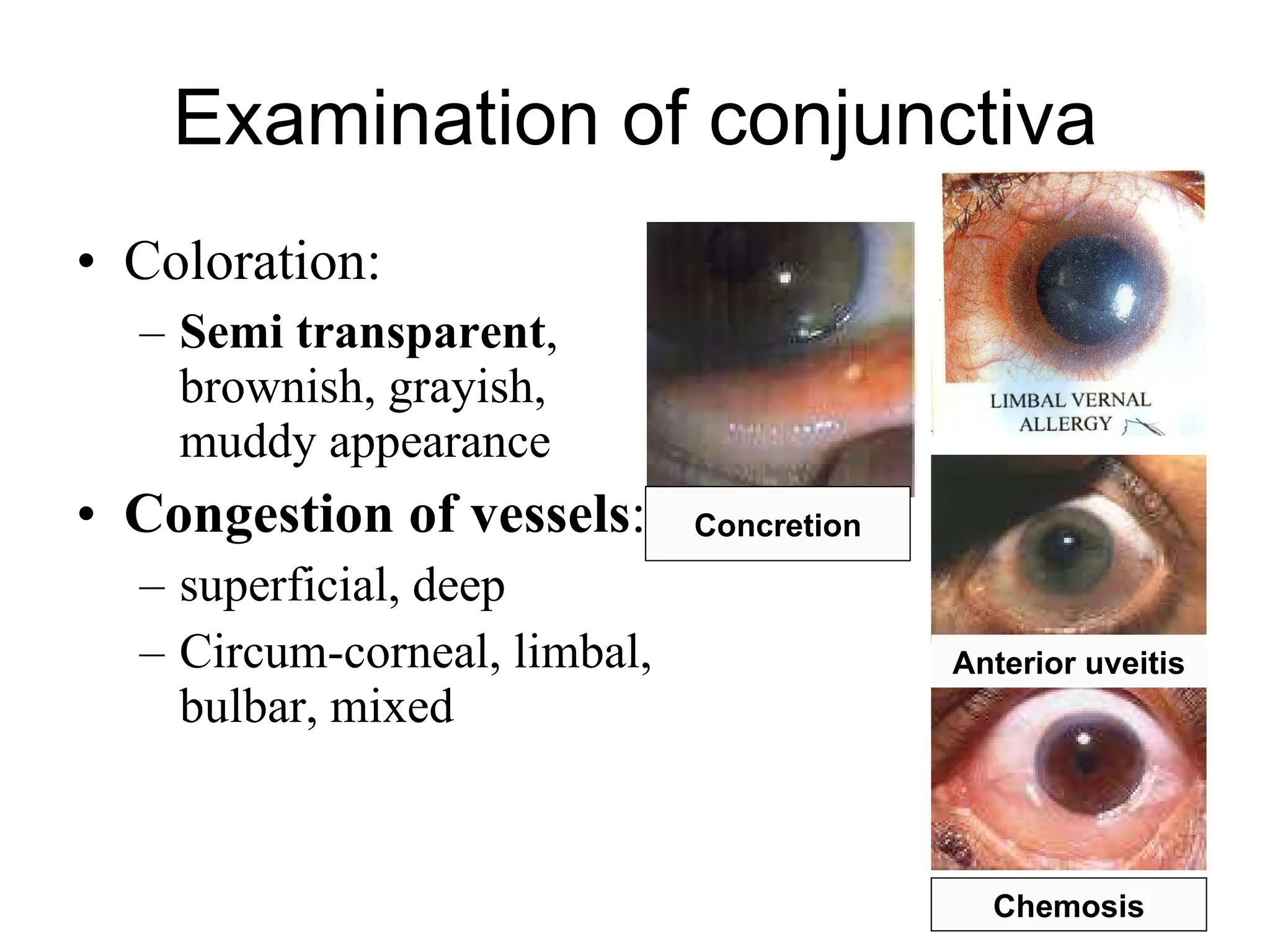 Examination of conjunctiva Coloration:  Semi transparent , brownish, grayish, muddy appearance Congestion of vessels :  superficial, deep Circum-corneal, limbal, bulbar, mixed Anterior uveitis Chemosis Concretion 