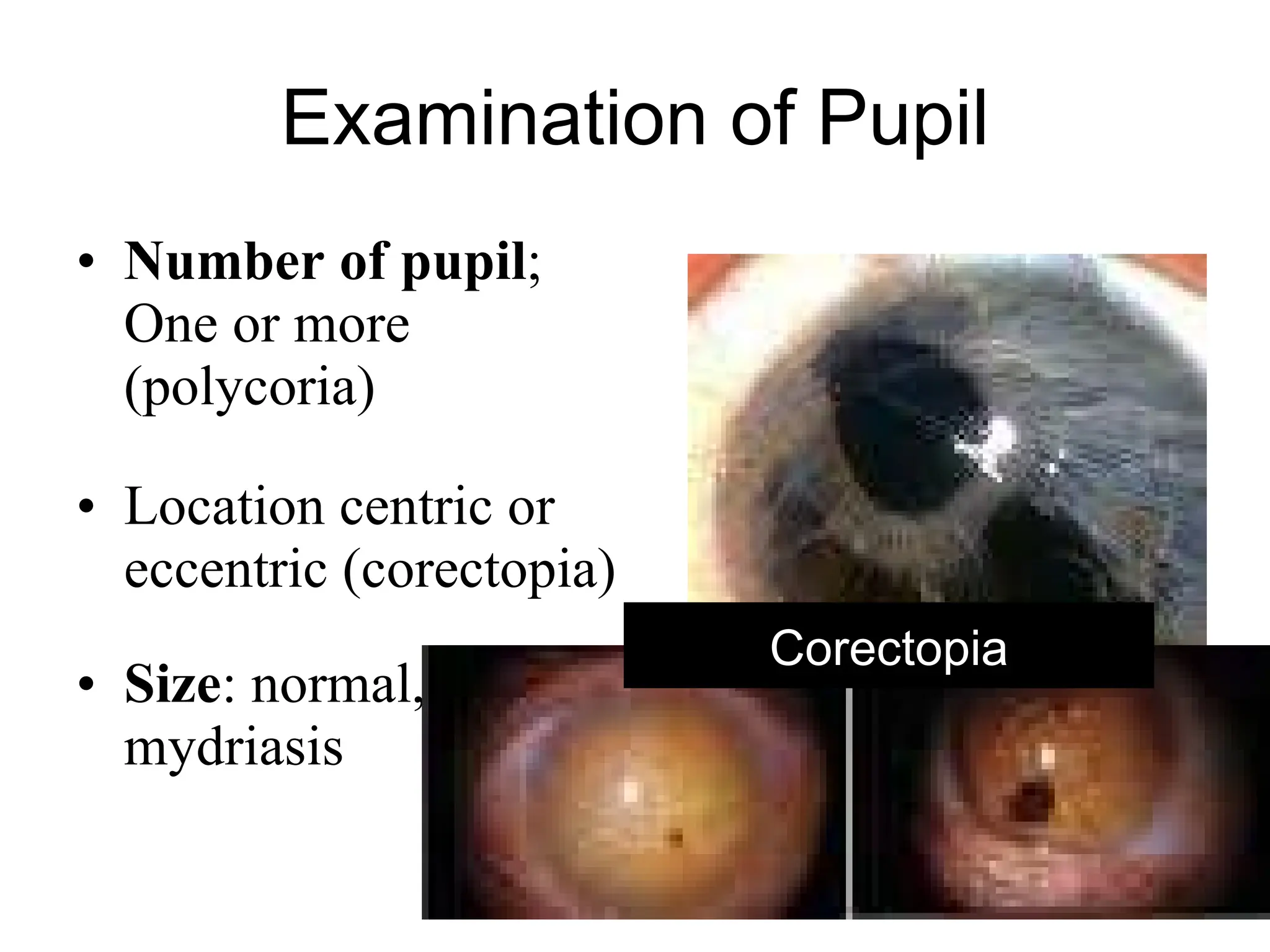 Examination of Pupil Number of pupil ; One or more (polycoria) Location centric or eccentric (corectopia) Size : normal, miosis, mydriasis Gauri S Shrestha, M.Optom Polycoria Corectopia 