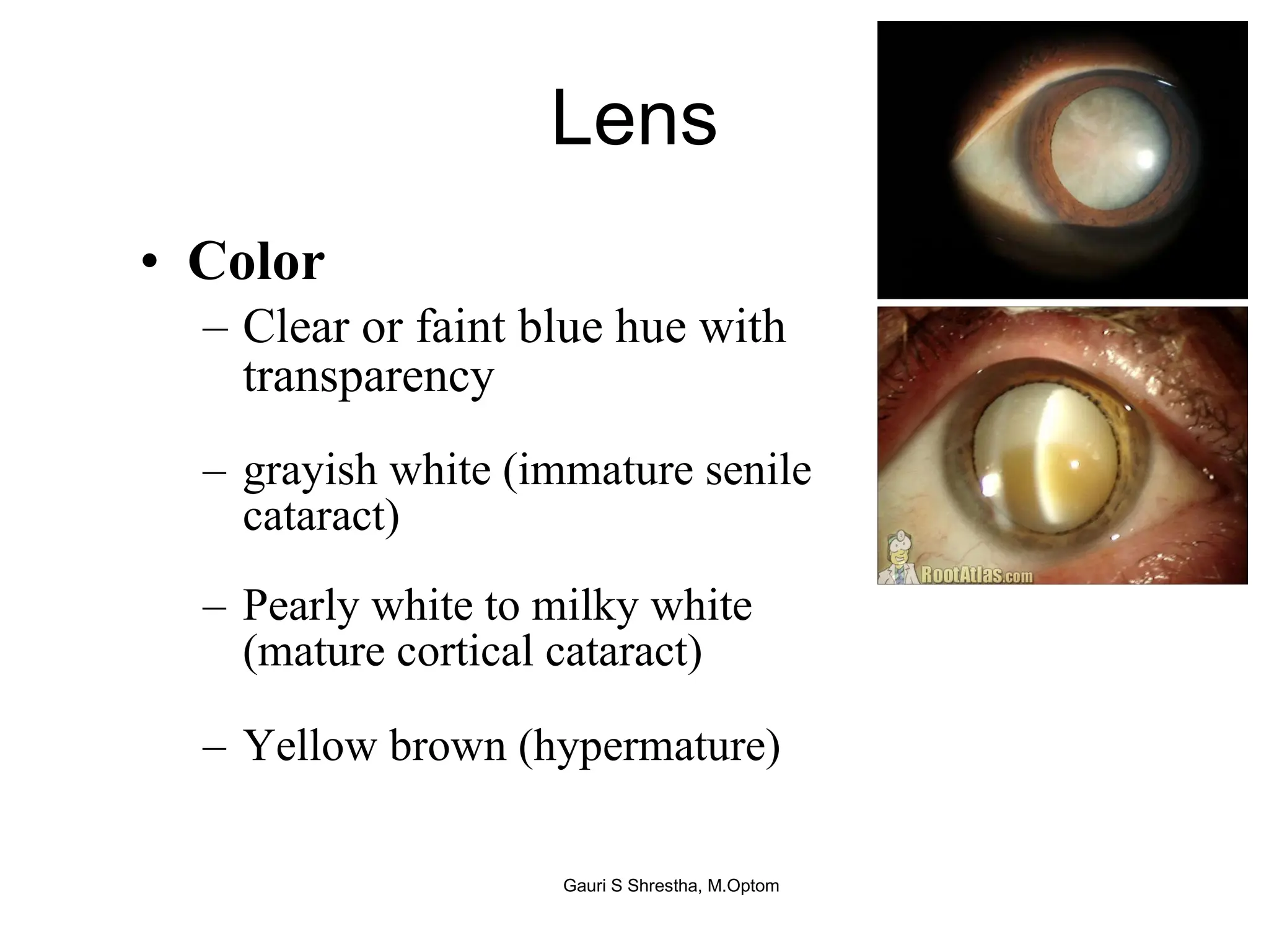 Lens Color Clear or faint blue hue with transparency grayish white (immature senile cataract) Pearly white to milky white (mature cortical cataract) Yellow brown (hypermature) Gauri S Shrestha, M.Optom 