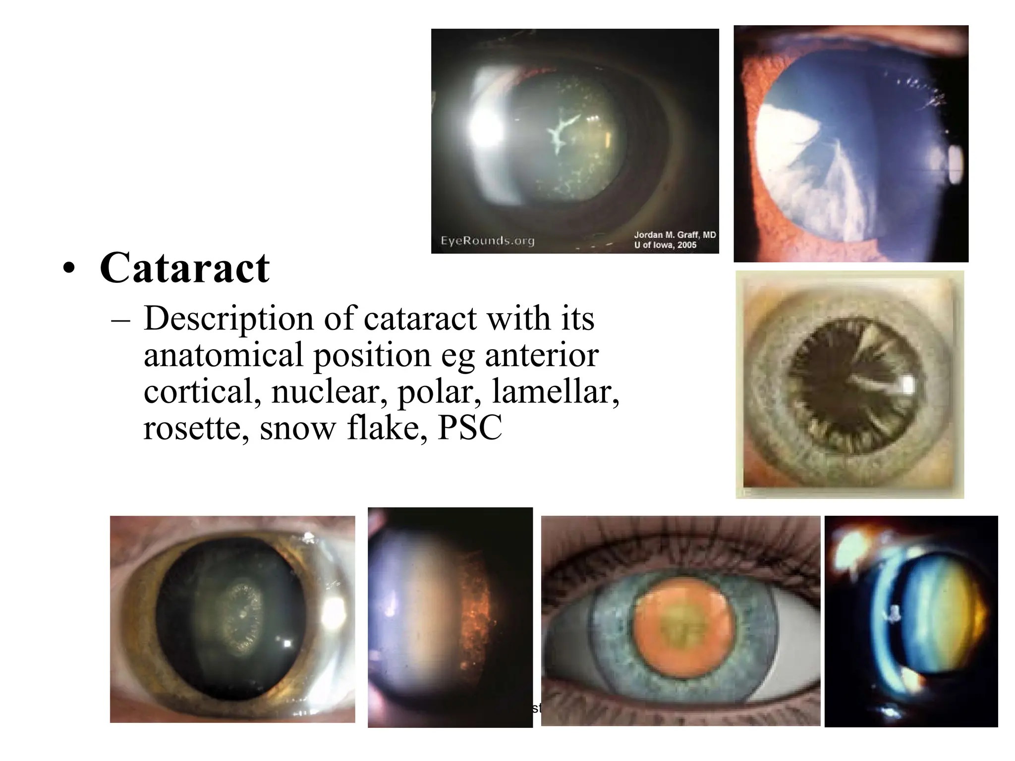 Lens Cataract Description of cataract with its anatomical position eg anterior cortical, nuclear, polar, lamellar, rosette, snow flake, PSC Gauri S Shrestha, M.Optom 