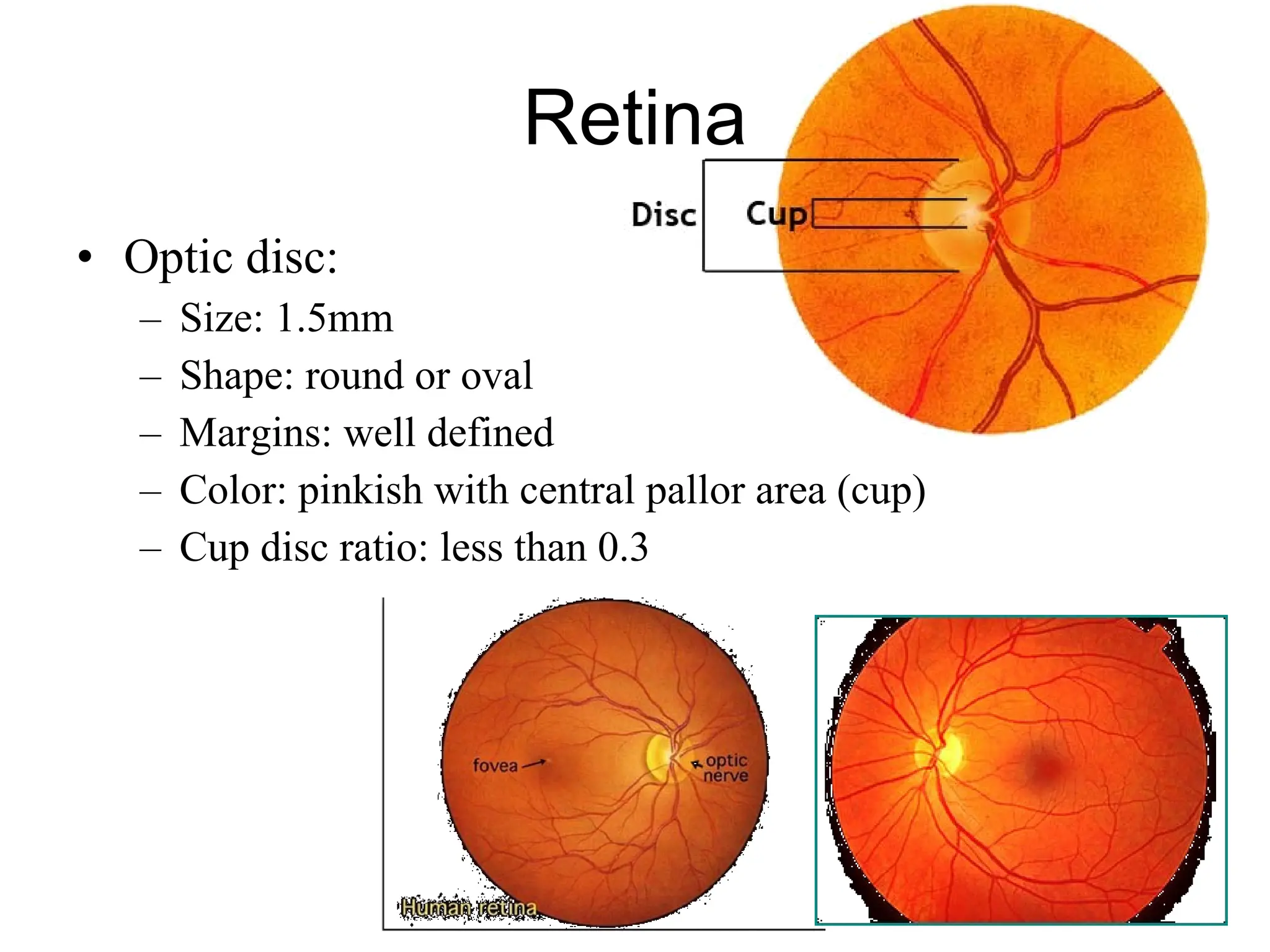 Retina Optic disc:  Size: 1.5mm Shape: round or oval Margins: well defined Color: pinkish with central pallor area (cup) Cup disc ratio: less than 0.3 