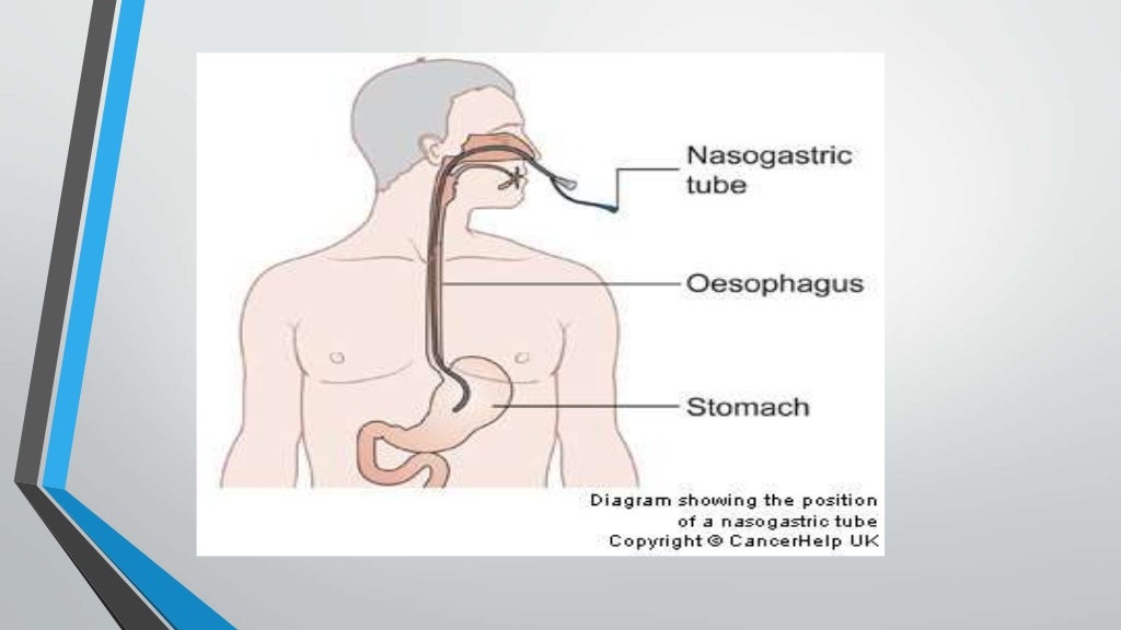 Nursing care for nasogastric tube patients