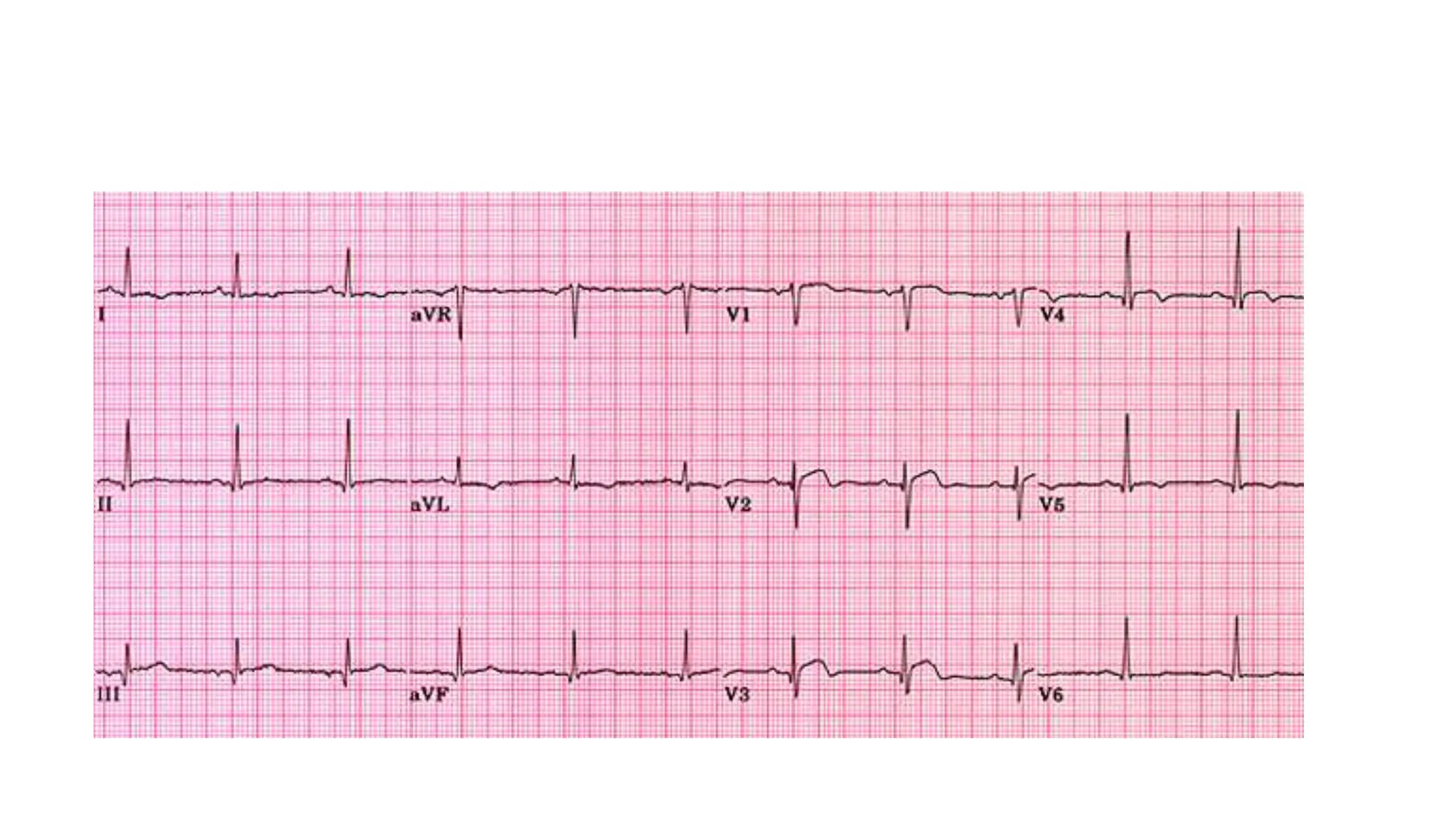 Myocardial Infarction Nursing.pptx | Heart and Cardiovascular Diseases ...