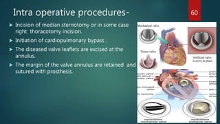 Bedside Resternotomy Nursing management of patient with cardiac surgeries. | PPTX