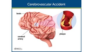Pathophysiology
The disruption in the blood flow initiates a complex series of cellular metabolic events.
 