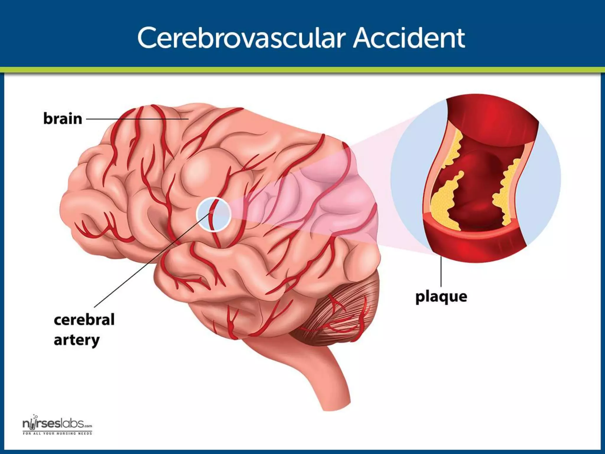 Pathophysiology
The disruption in the blood flow initiates a complex series of cellular metabolic events.
 